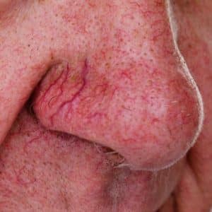 spider veins on nose