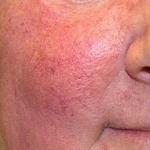 broken capillaries signs of an alcoholic face